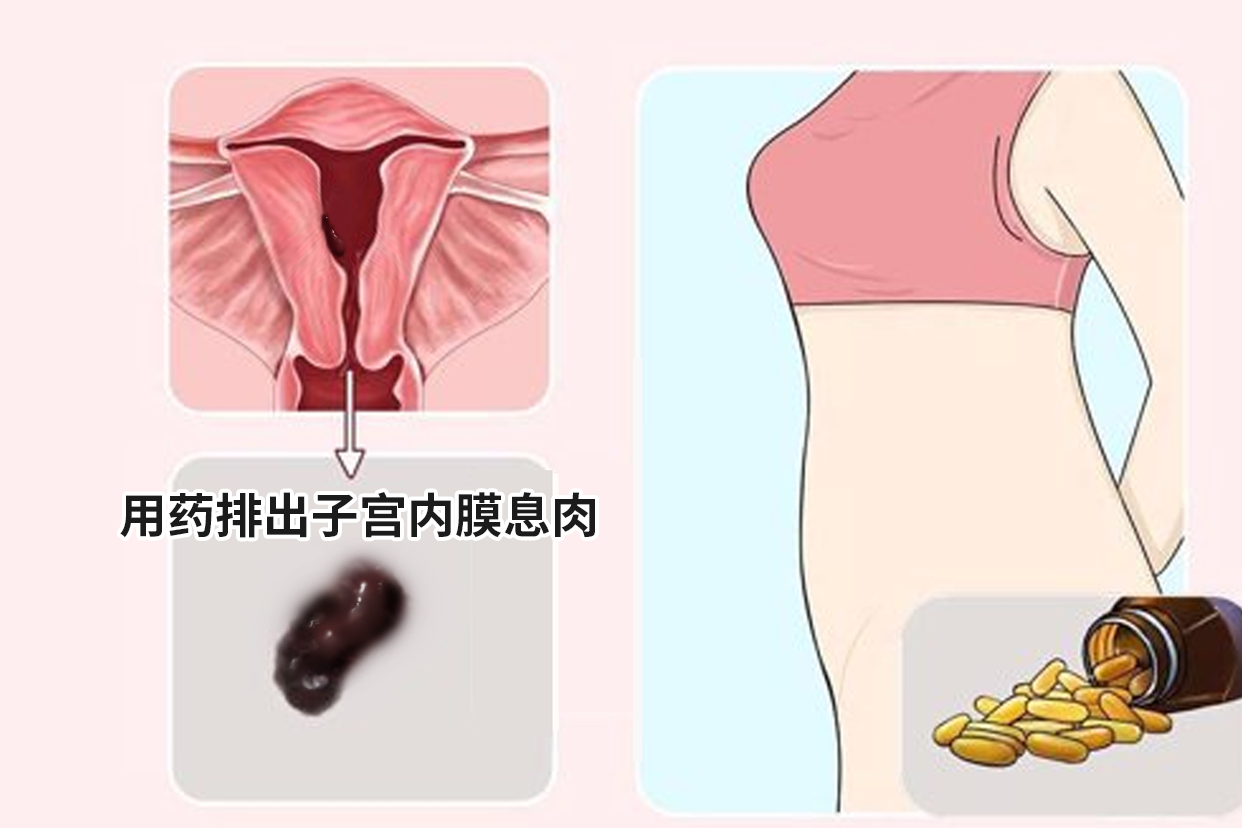 用药排出子宫内膜息肉图片