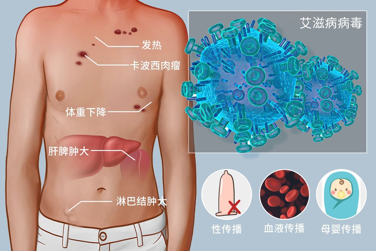 艾滋病图片