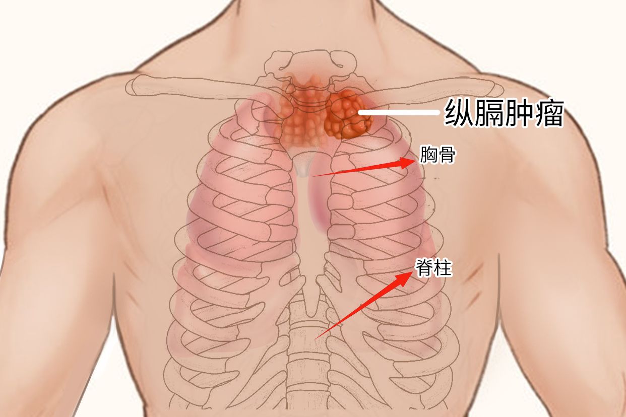 纵隔肿瘤图片