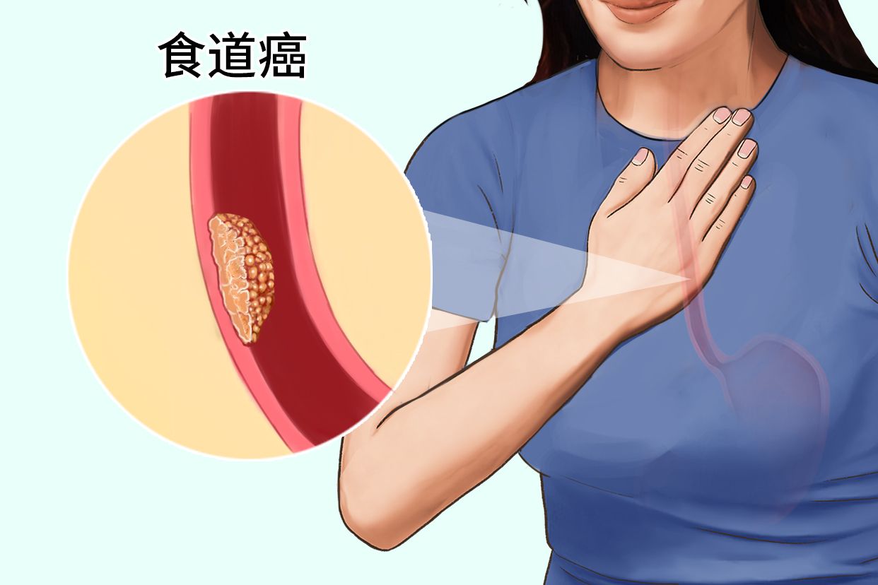 女性食道癌在喉咙的部位图片