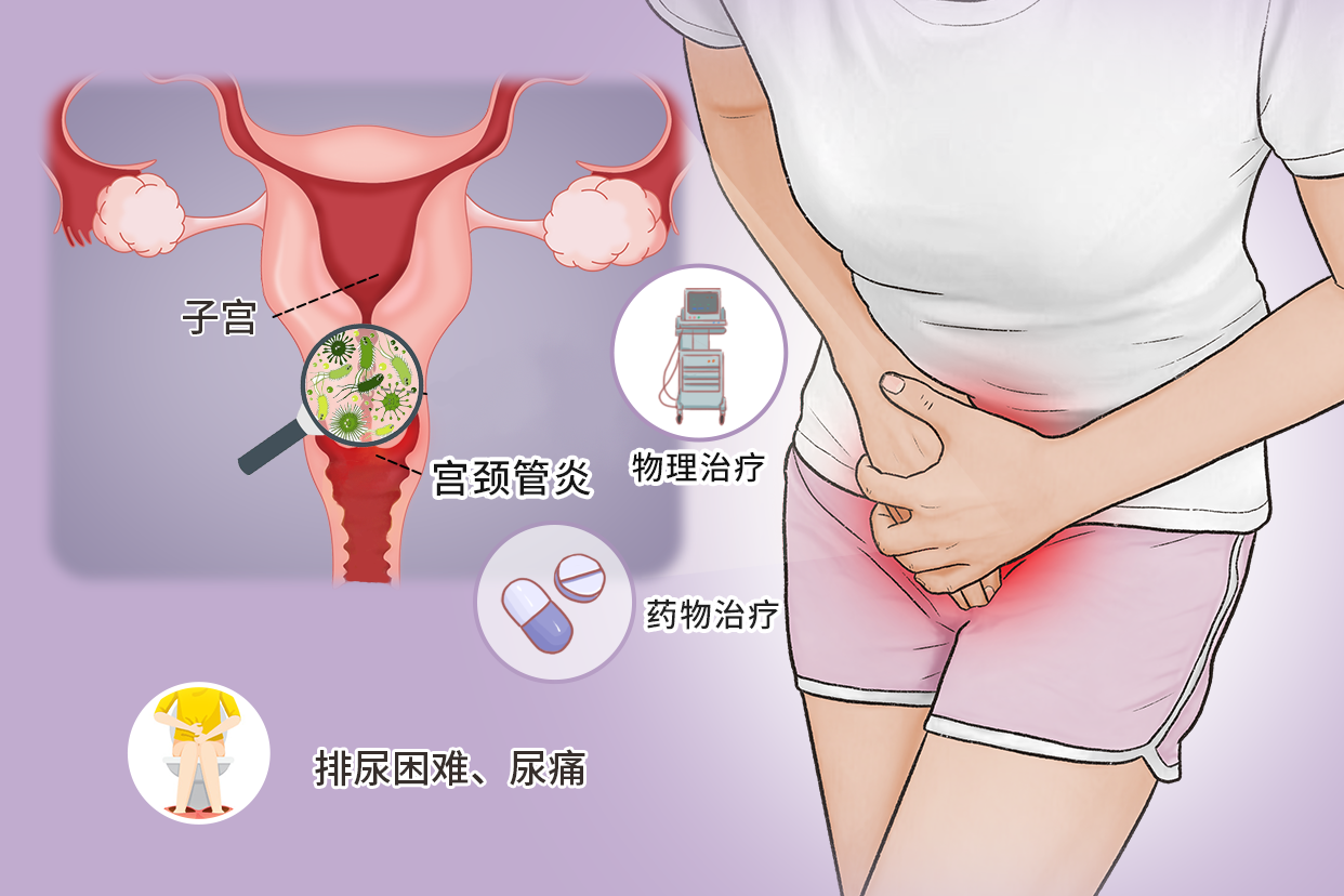 宫颈管炎症状图片