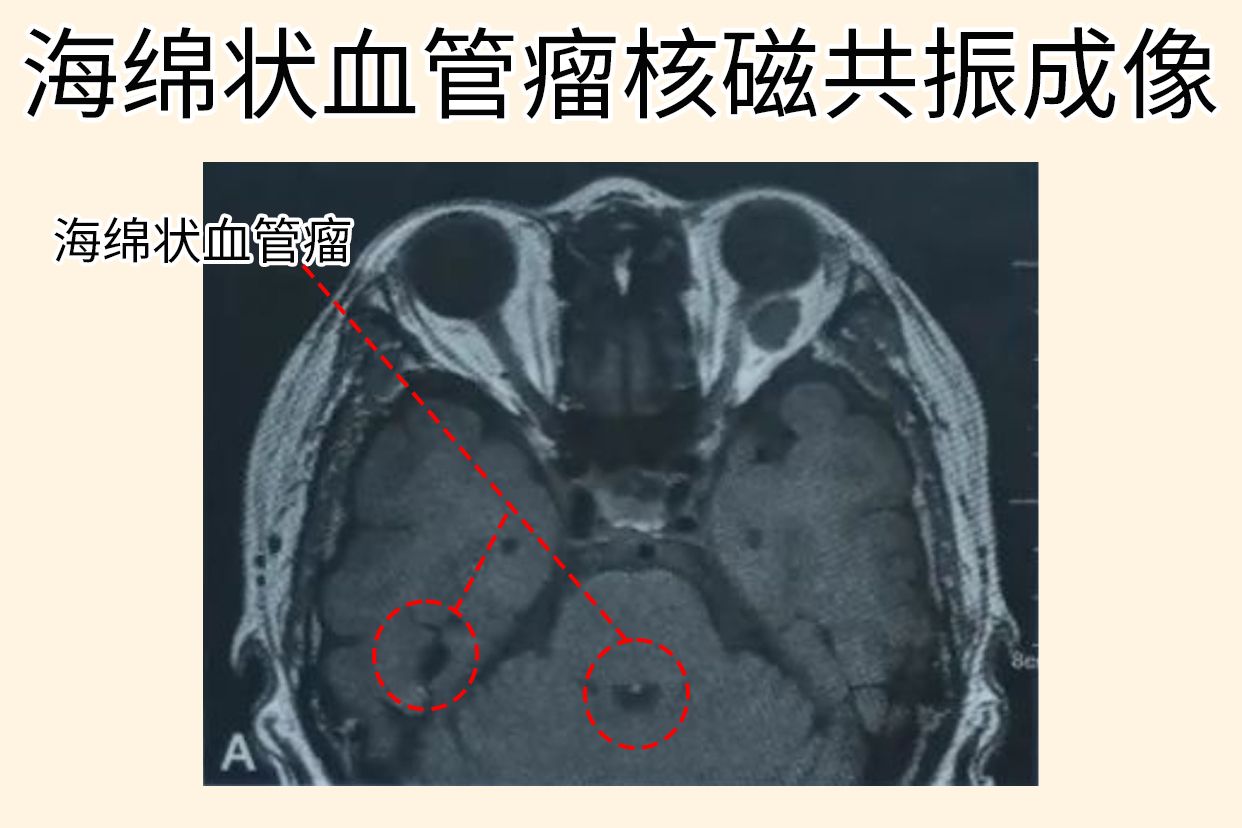 海绵状血管瘤核磁共振成像图