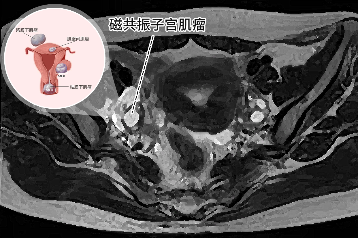 子宫肌瘤核磁共振检查图片