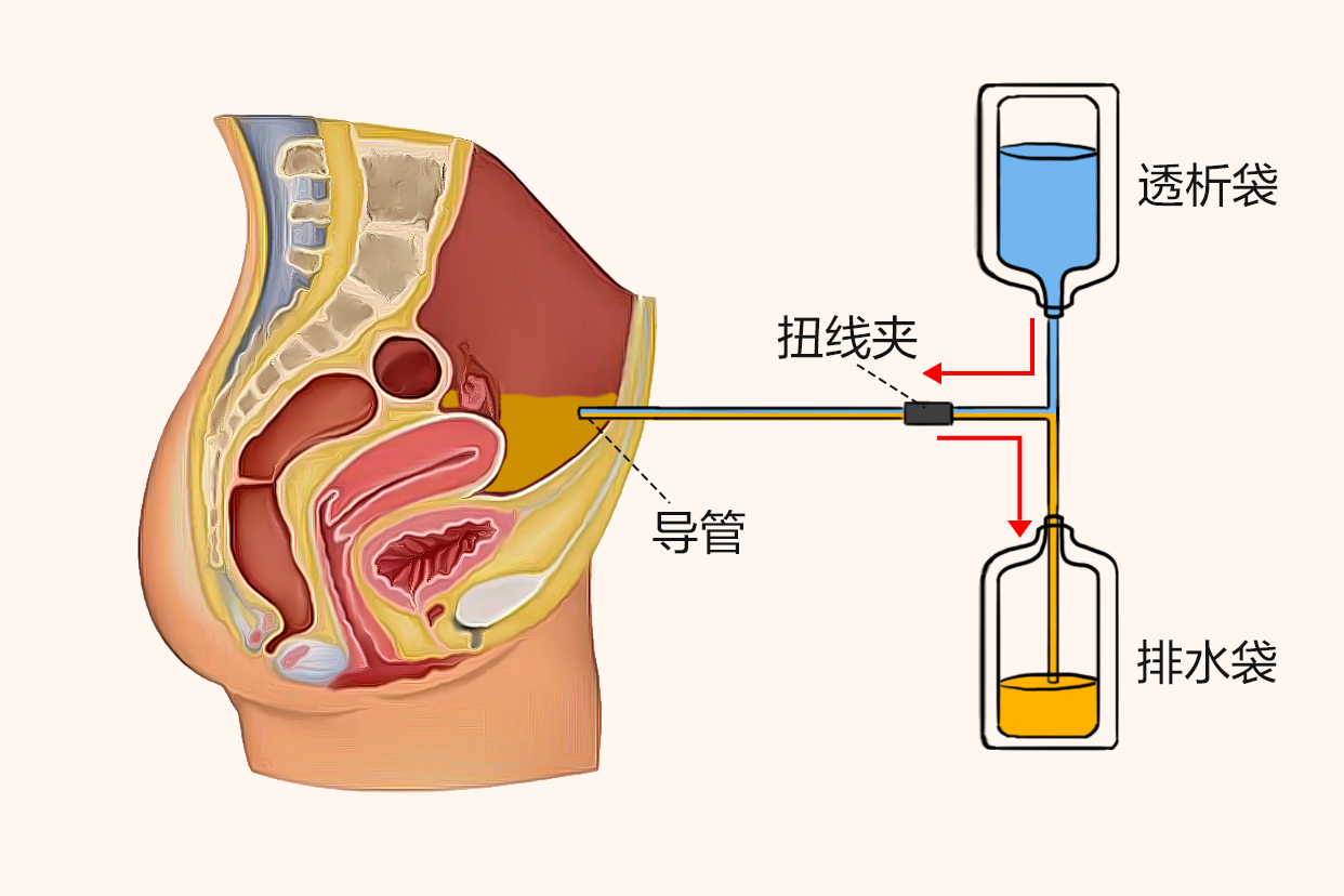 腹膜透析置管术示意图