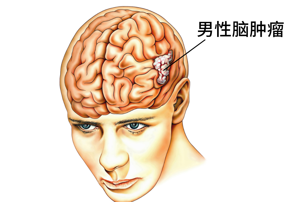 男性脑肿瘤图片