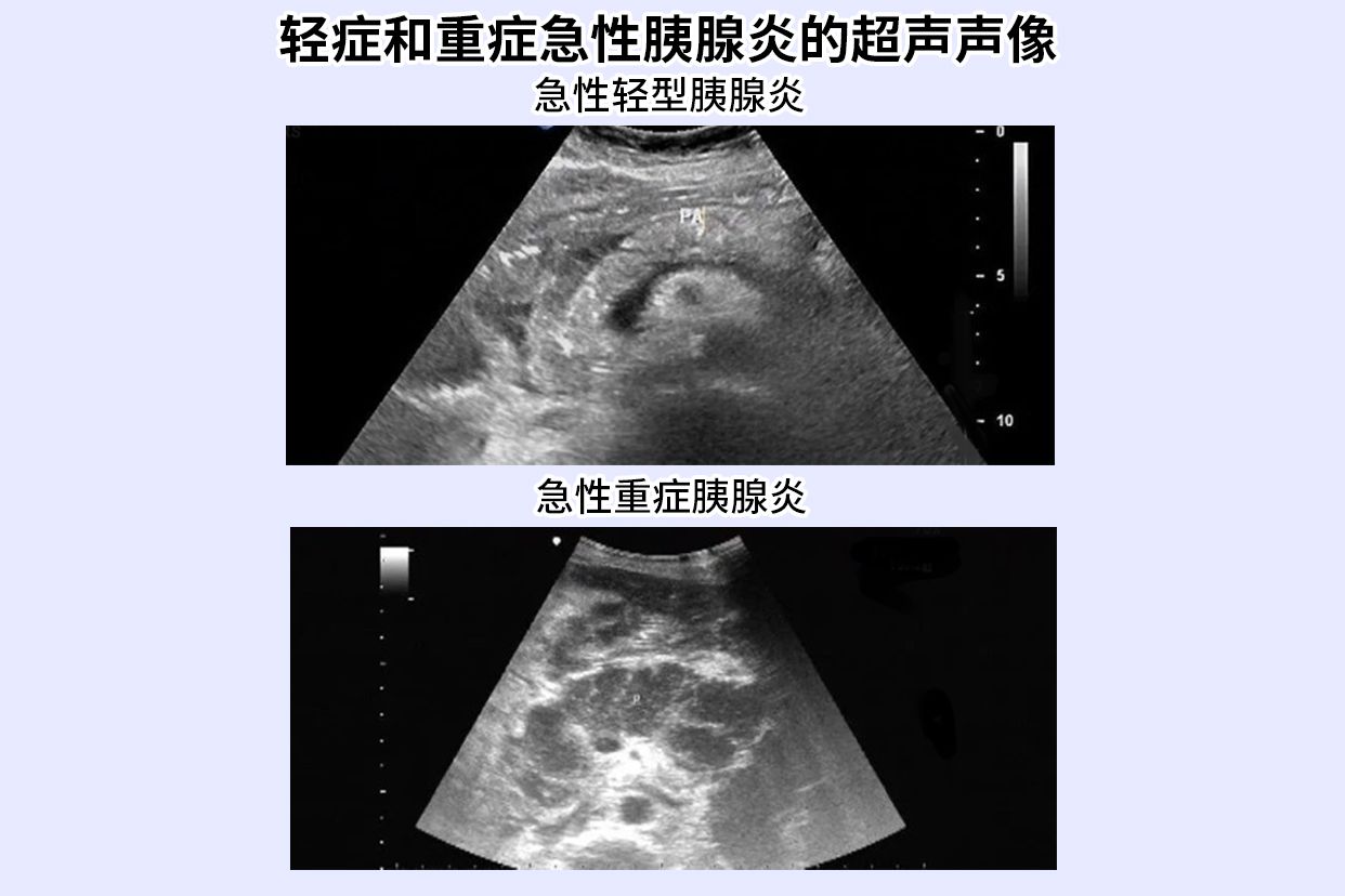 急性轻型和急性重症胰腺炎超声图