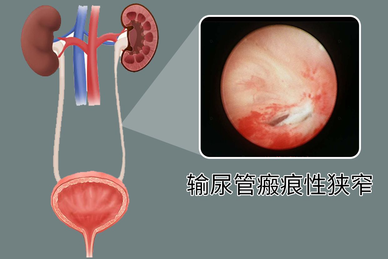 输尿管瘢痕性狭窄图片