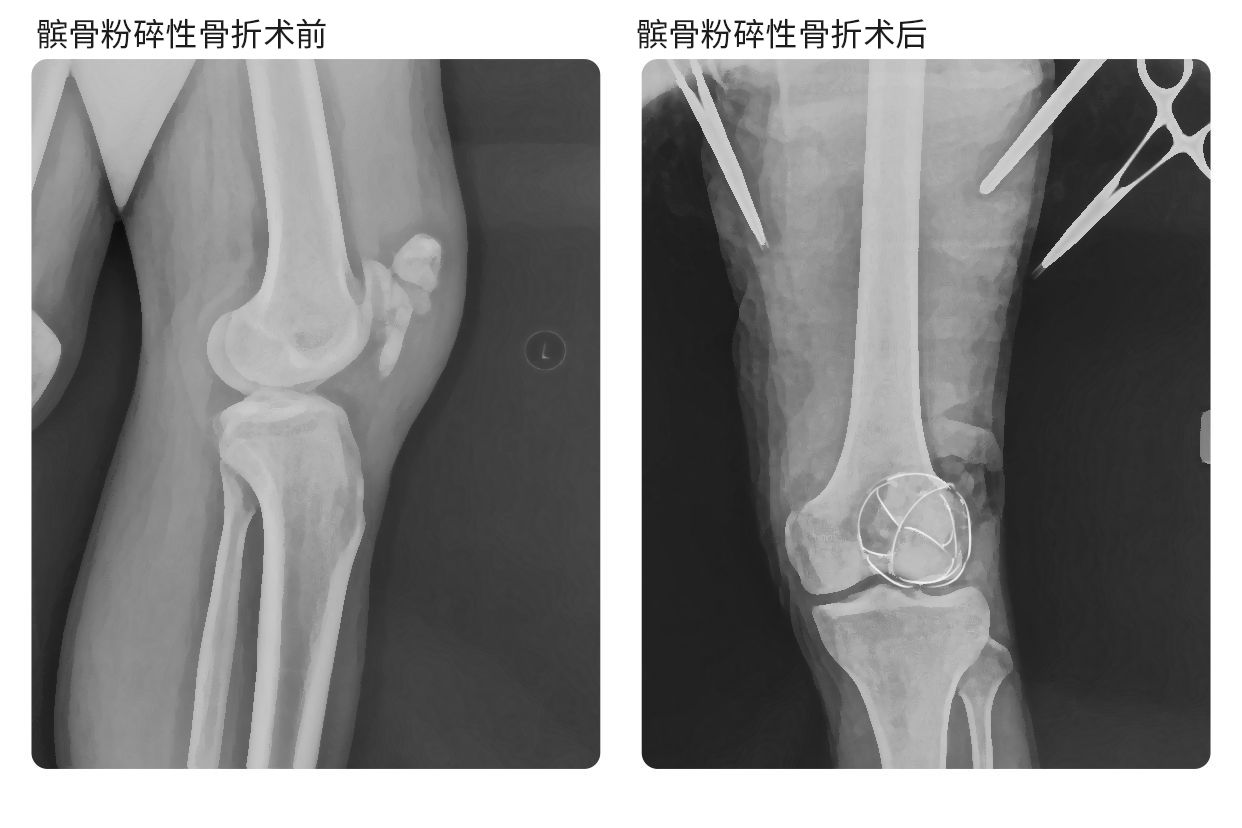 髌骨粉碎性骨折术后图