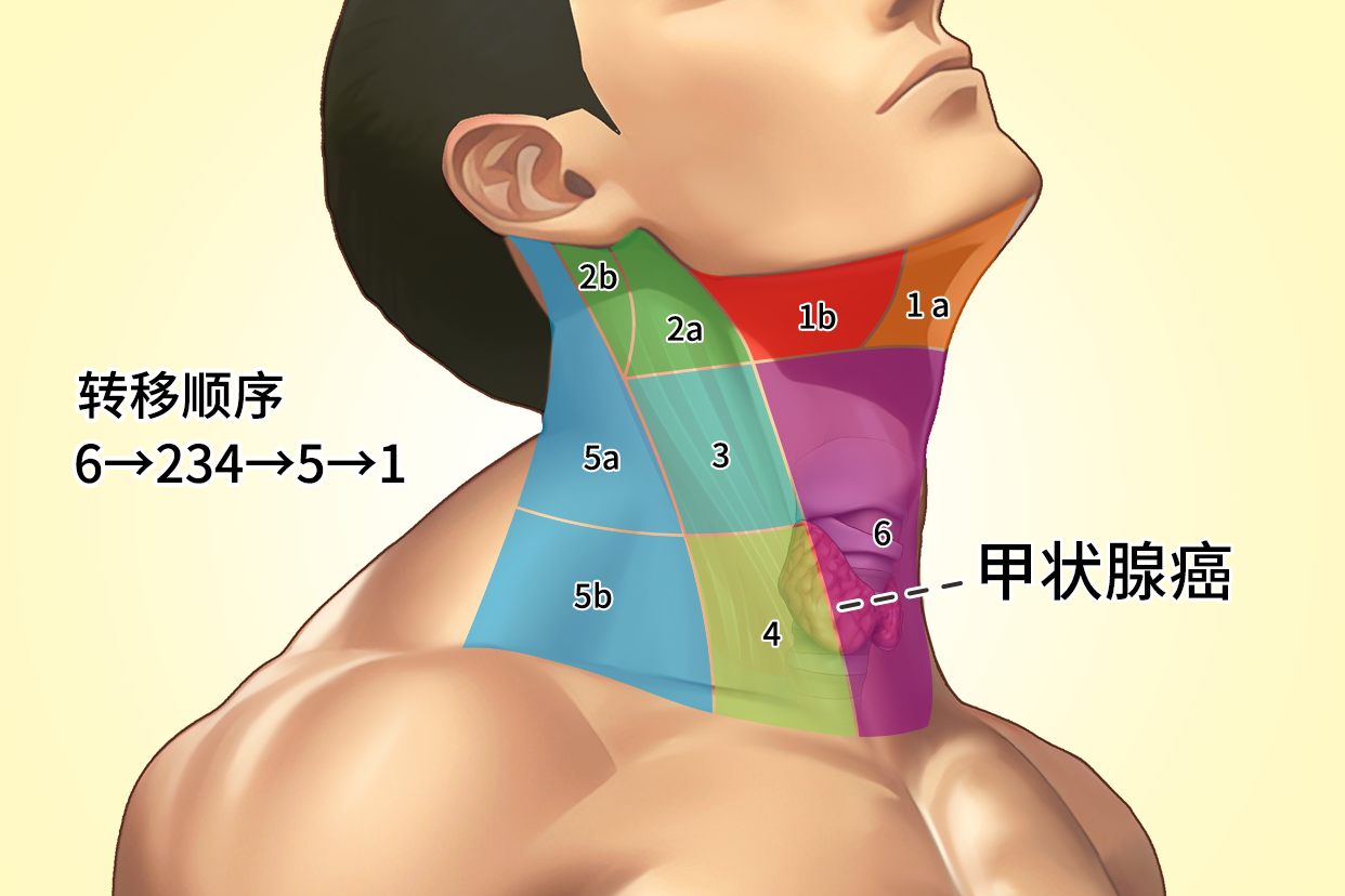 甲状腺癌转移顺序图