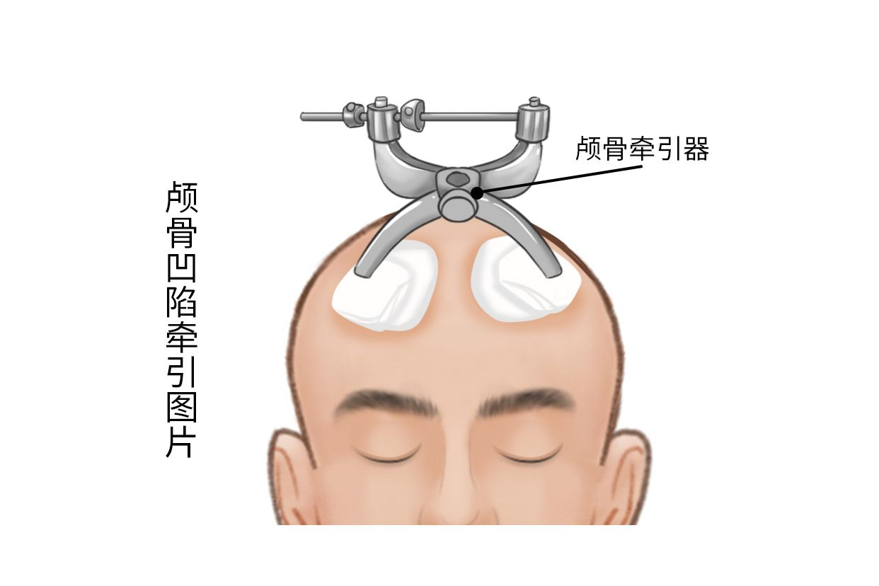 颅底凹陷牵引图