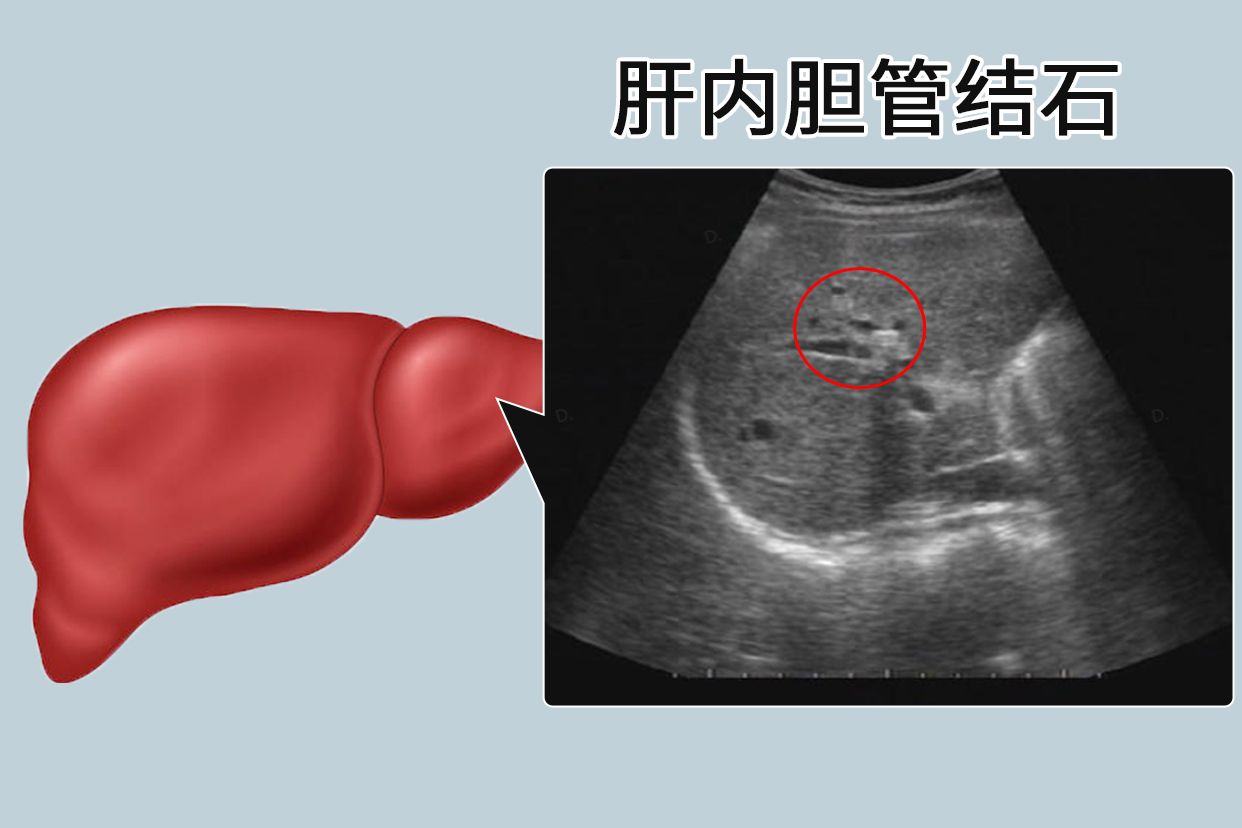 肝内胆管B超图片