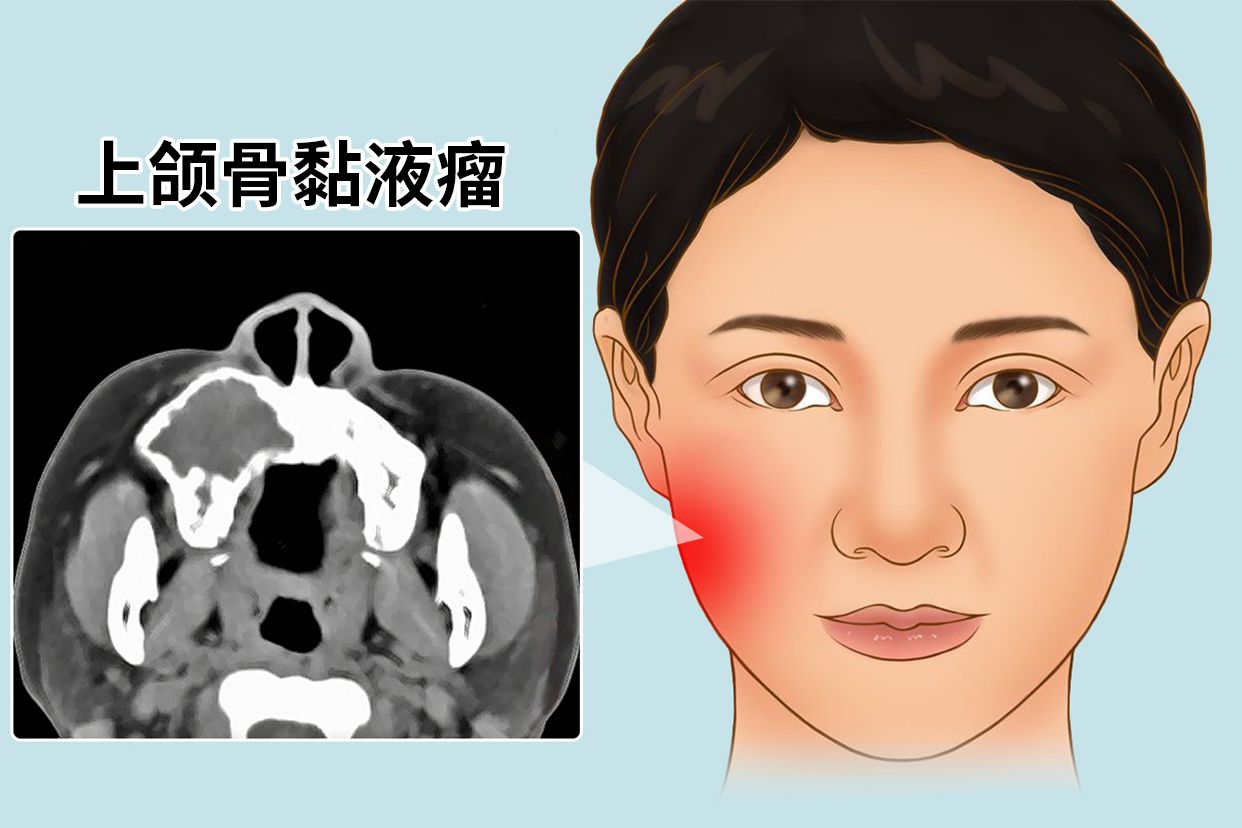 上颌骨黏液瘤