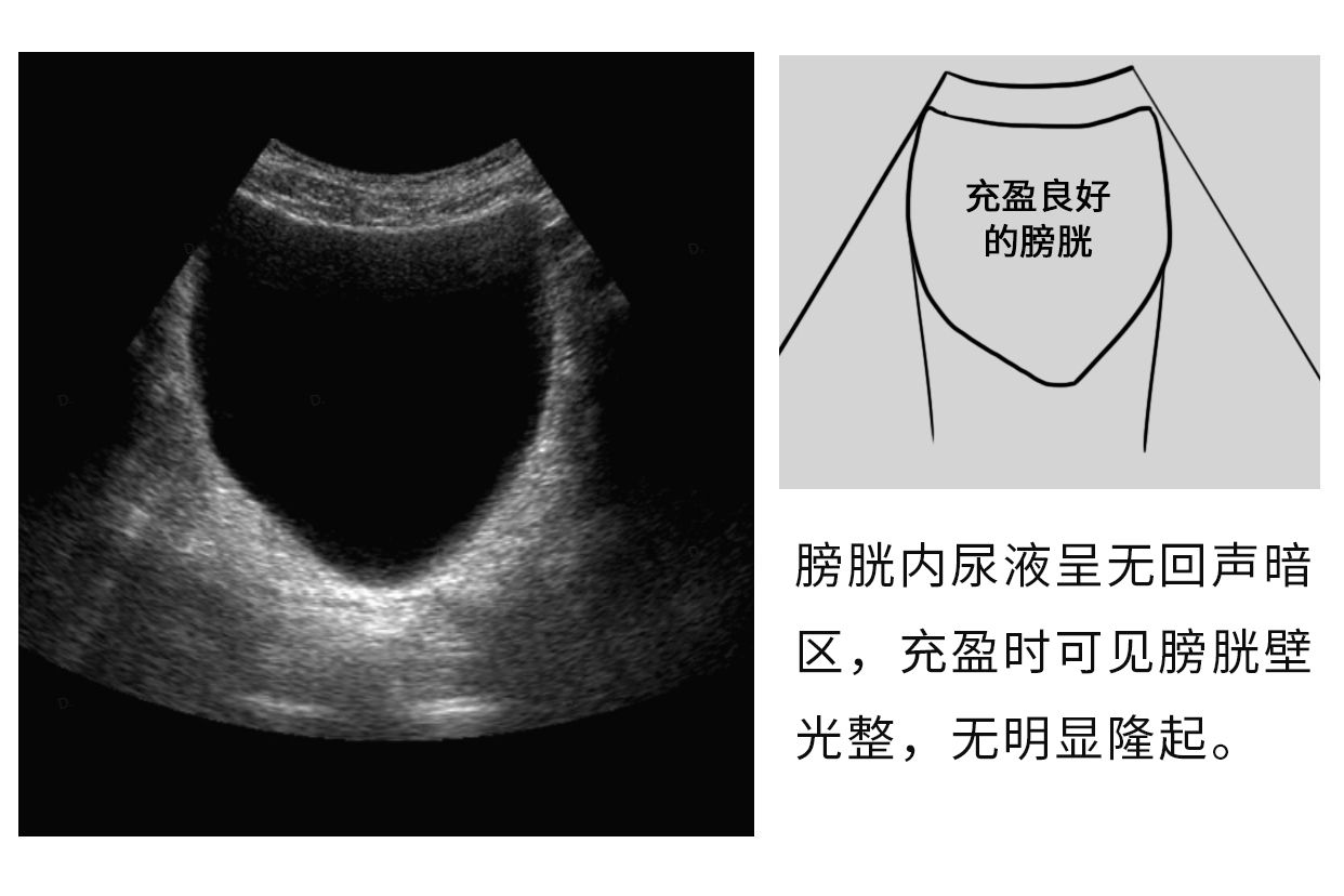 正常膀胱的超声图