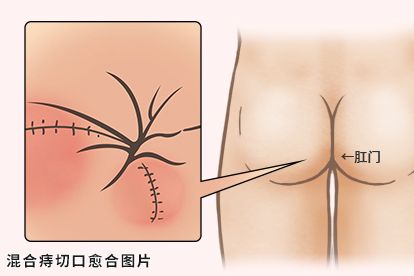 混合痔切口愈合图