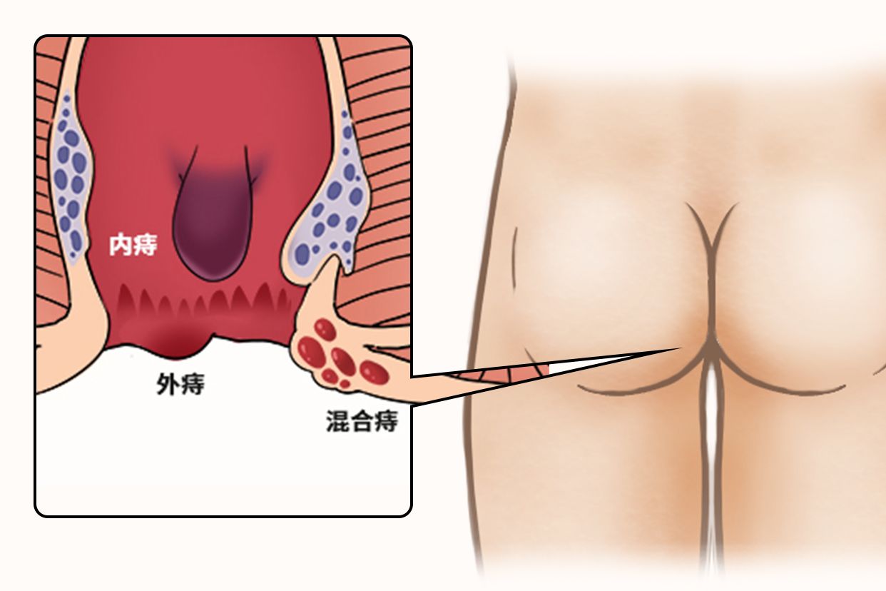 臀部长痔图片