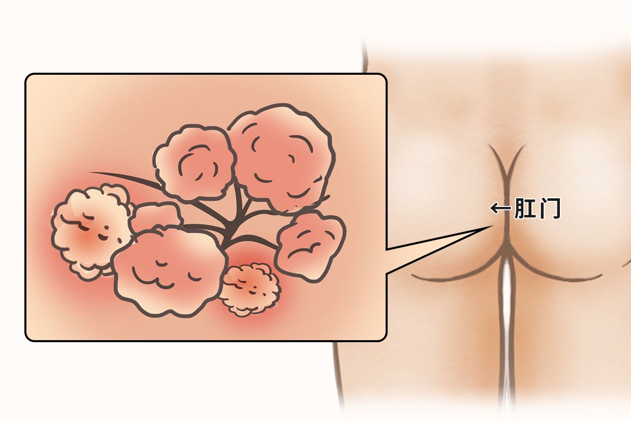 肛瘘图片