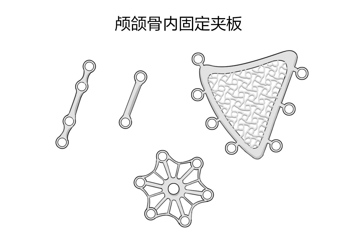 颅颌骨内固定夹板图片