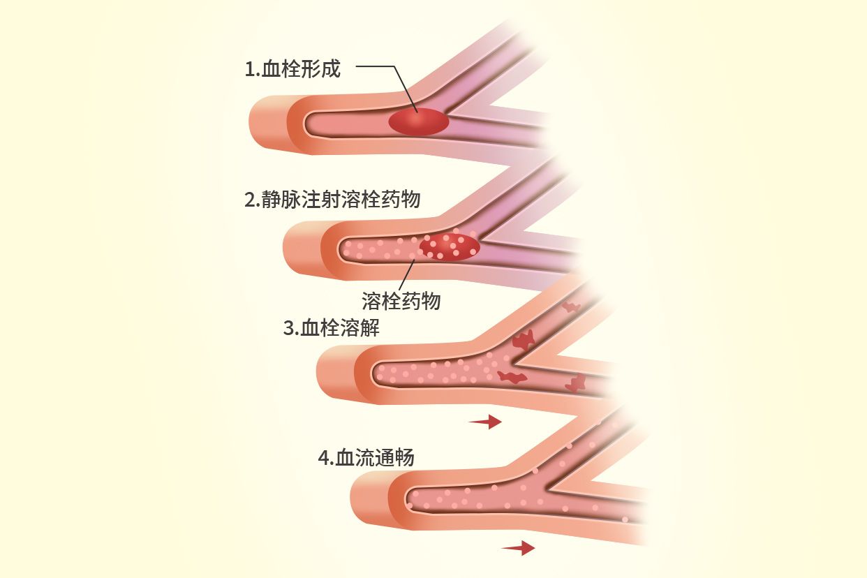 溶栓治疗图片