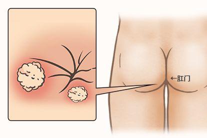 肛门尖锐湿疣图片