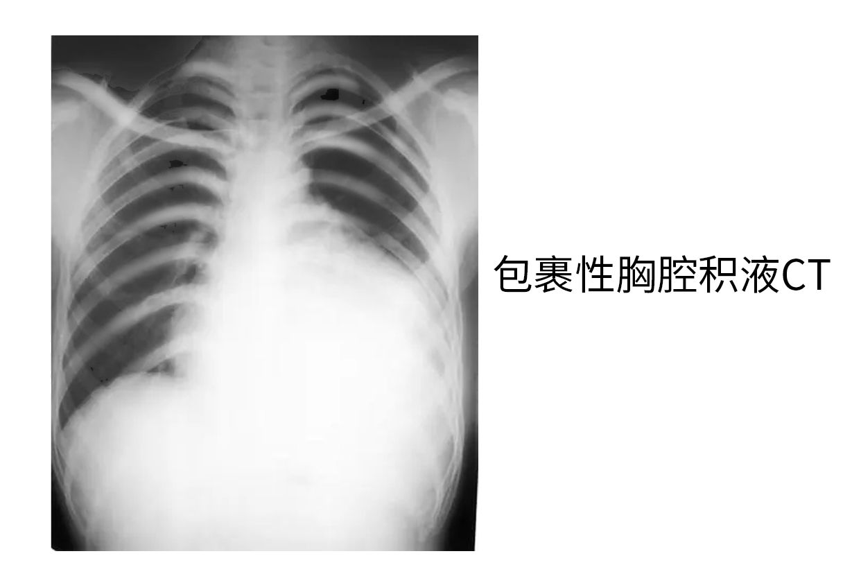 包裹性胸腔积液CT图片