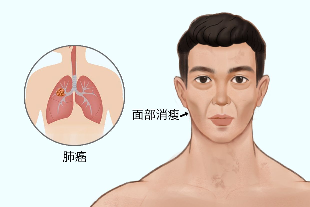 肺癌面部特征高清图片