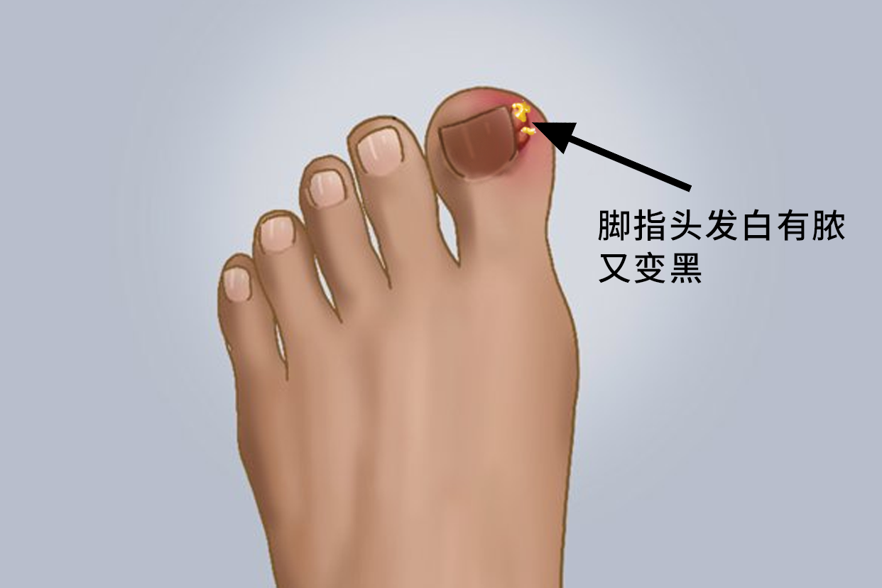 脚指头有脓又变黑图片