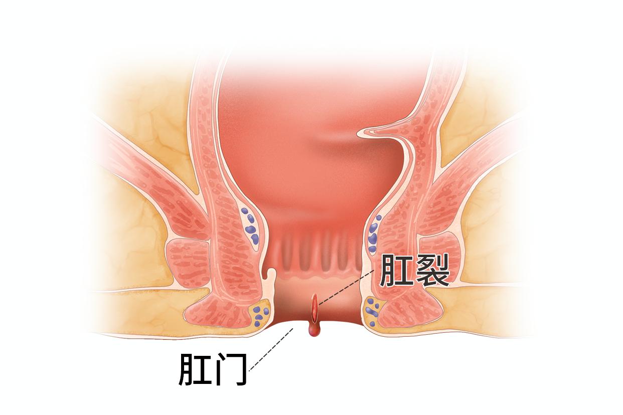 肛裂的症状图片 正常图片