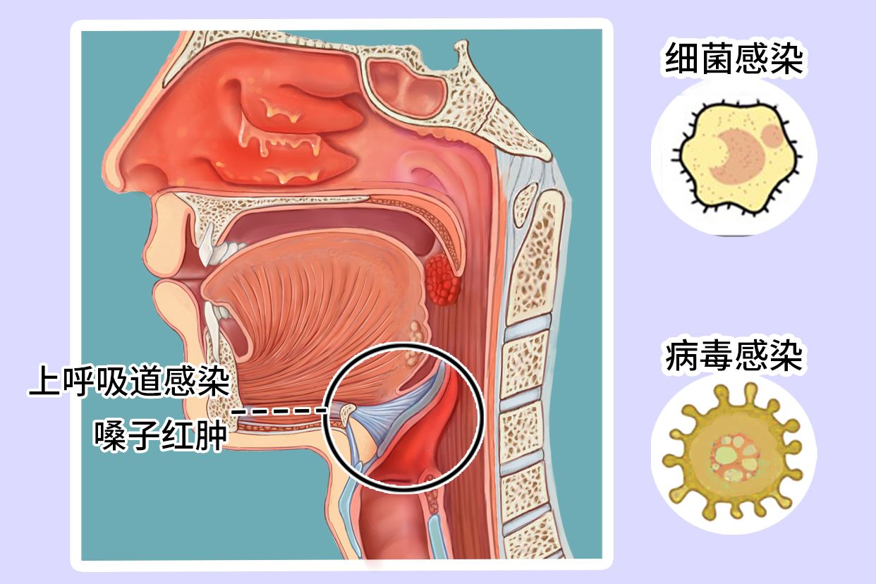 上呼吸道感染嗓子红肿图