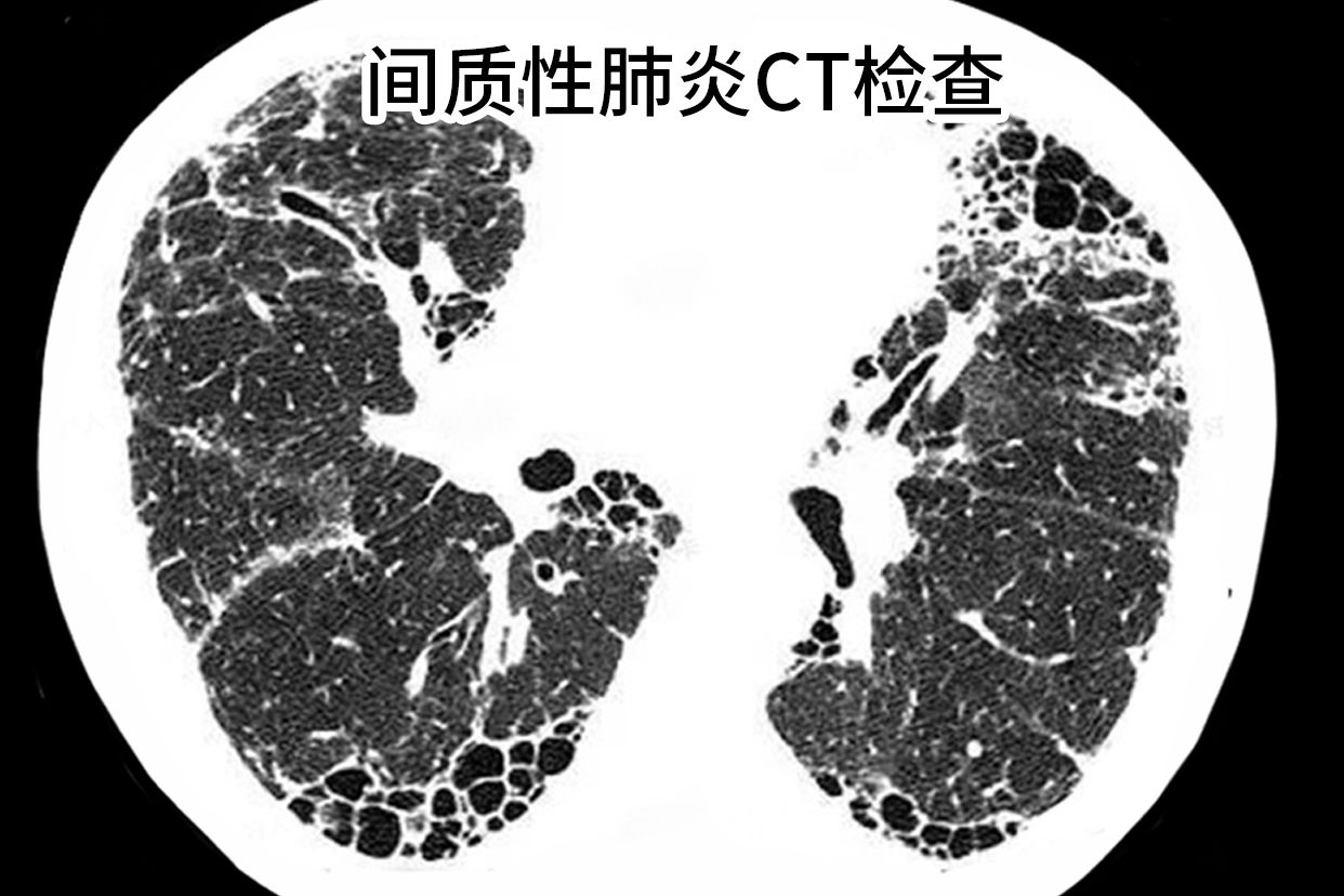 间质性肺炎CT检查图片