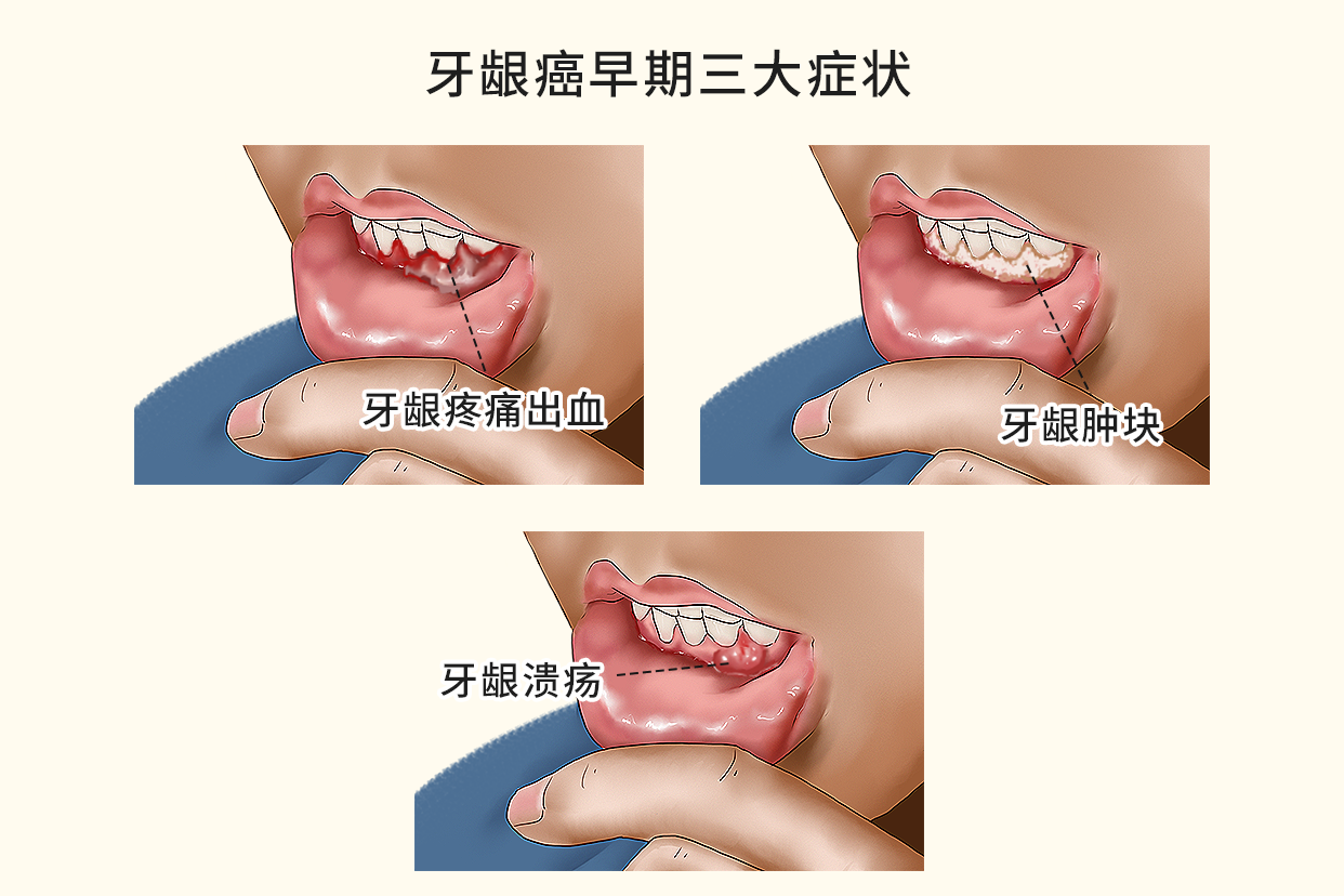 牙龈癌早期三大症状图