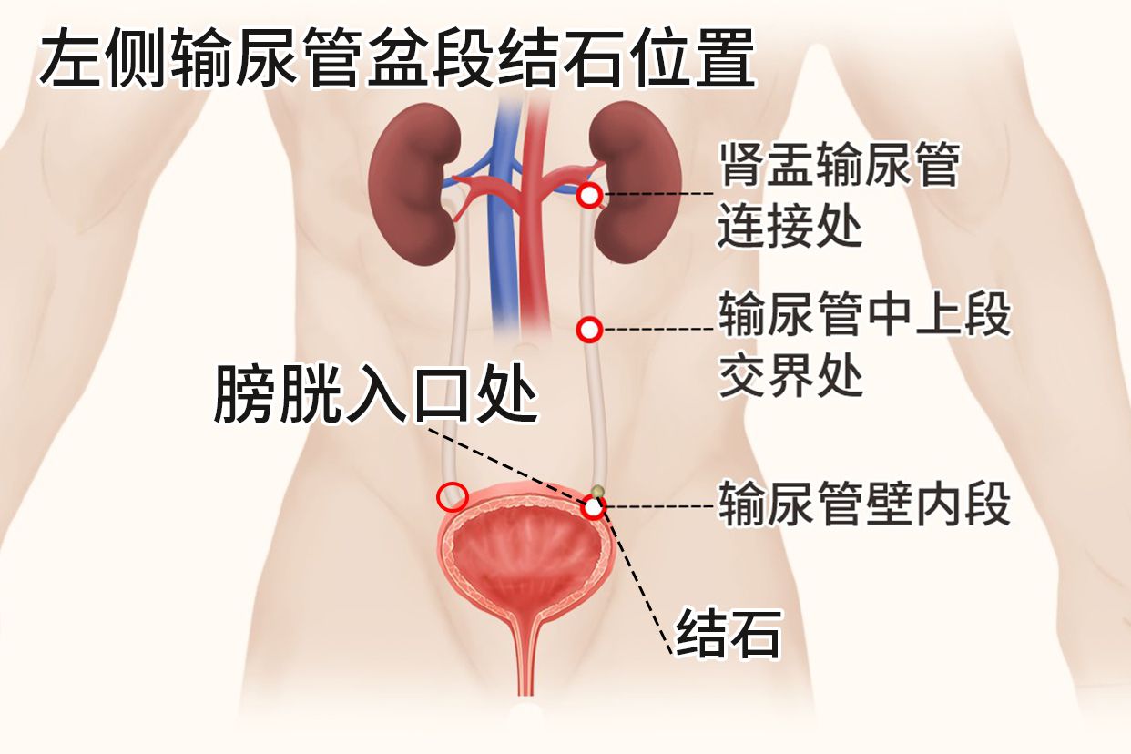 左侧输尿管盆段结石位置图