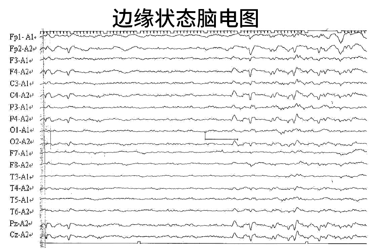 边缘状态脑电图