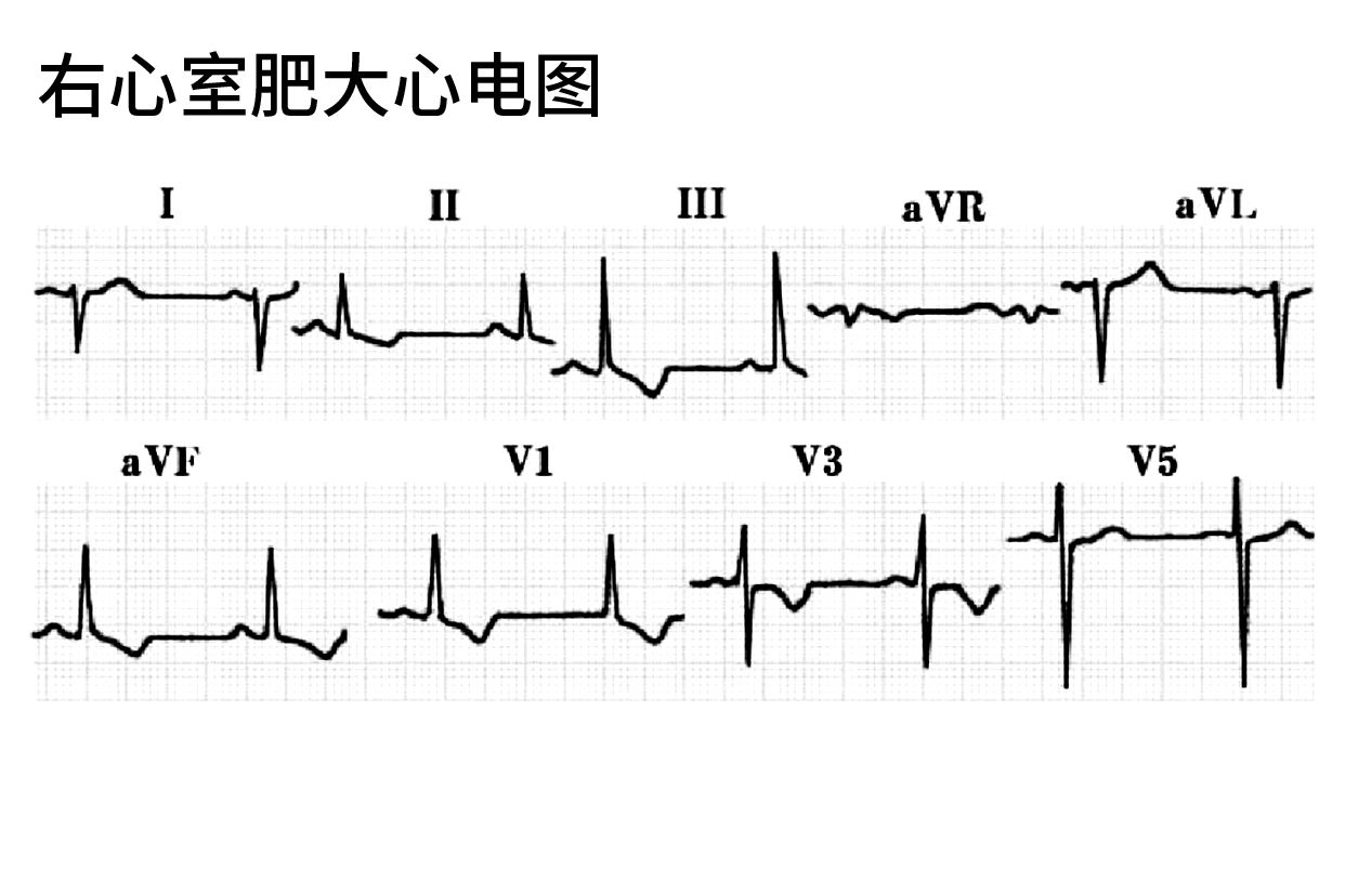右心室心电图图片