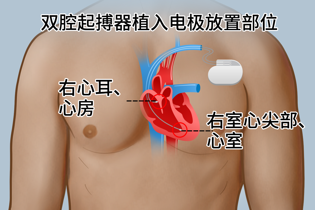 起搏器安放的位置图图片