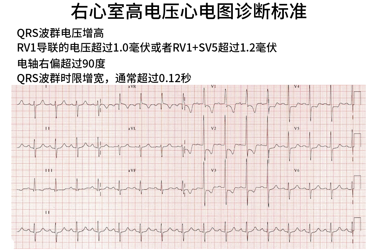 右心室心电图图片