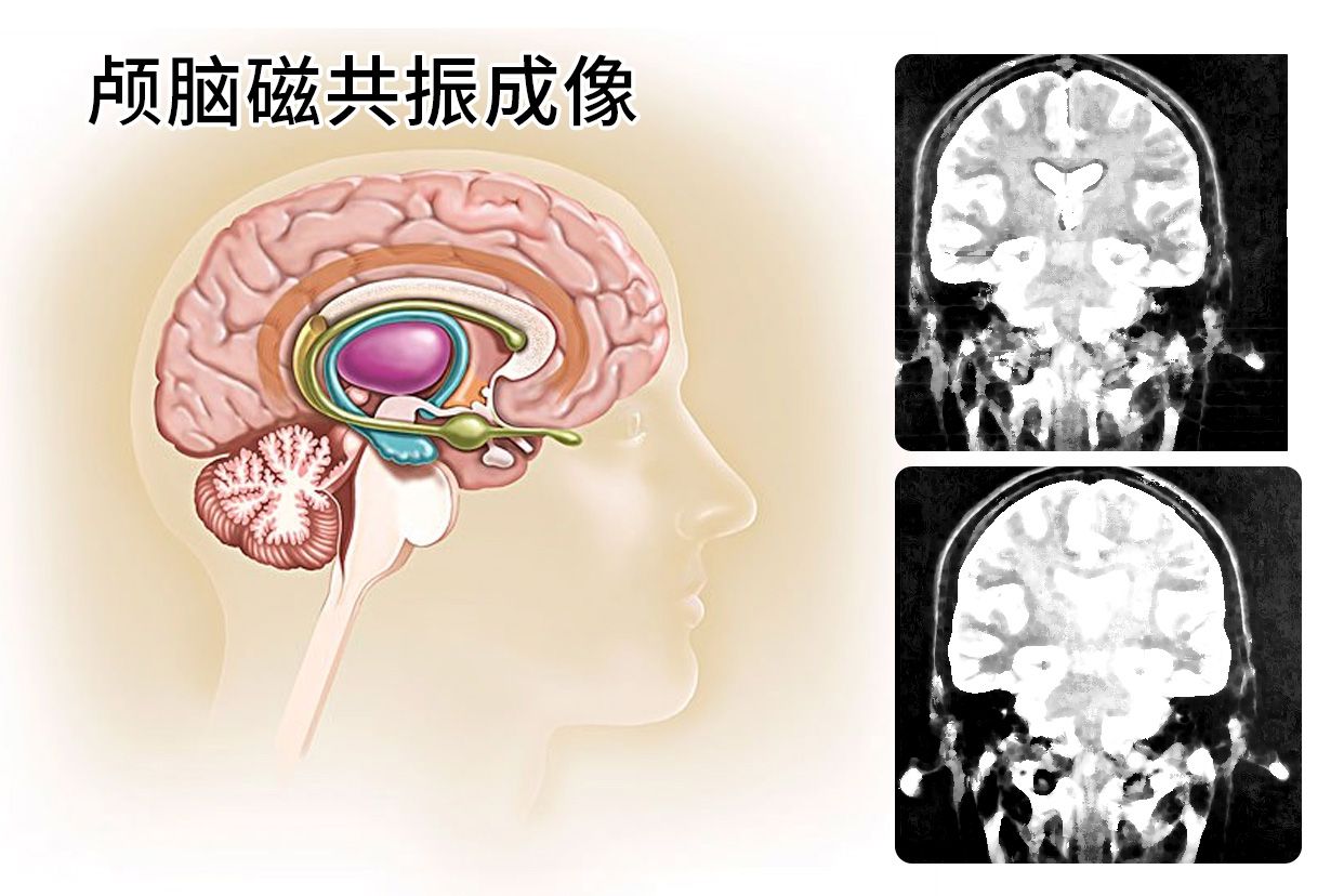 颅脑磁共振成像图