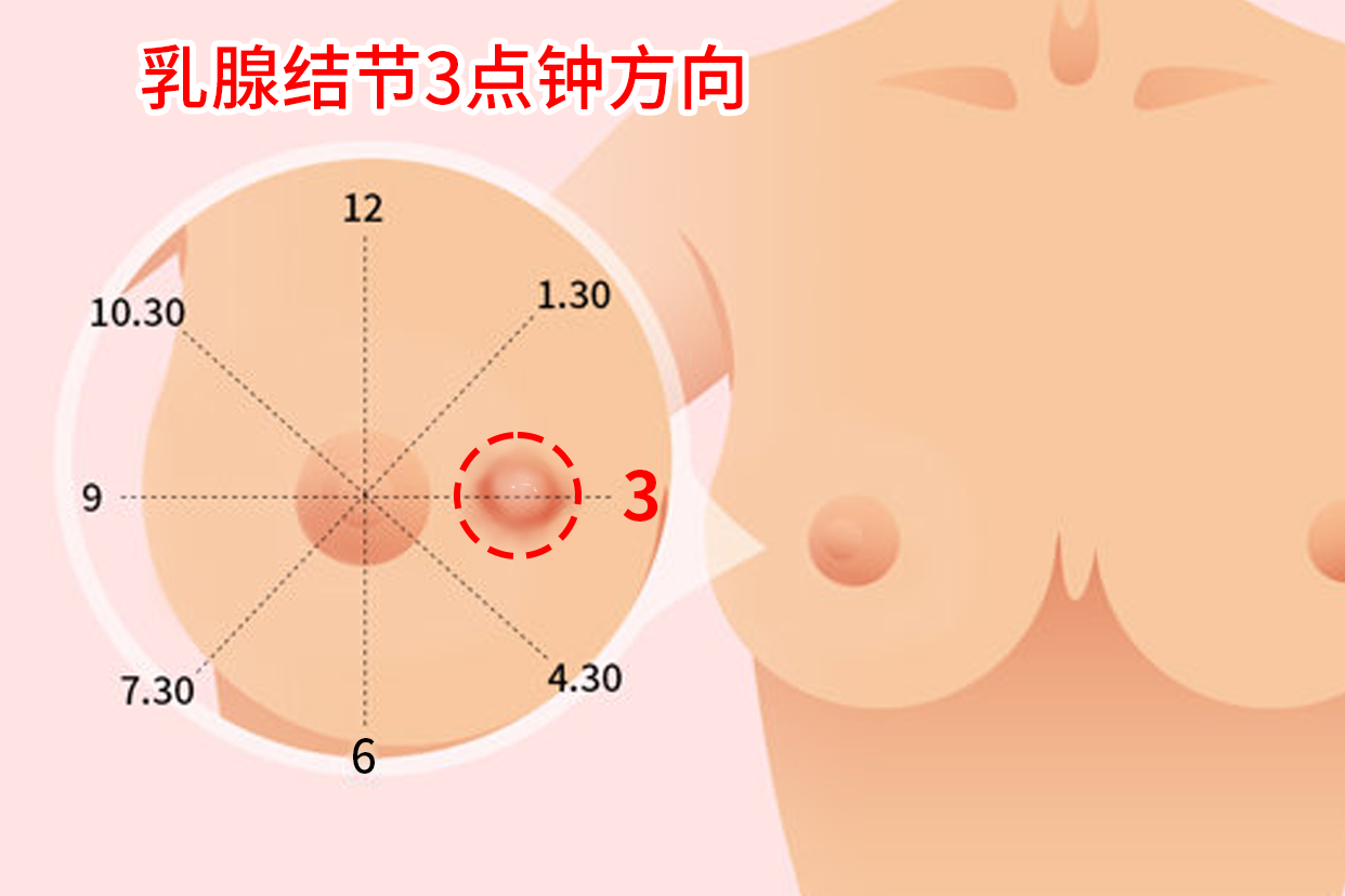 乳腺结节3点钟方向图
