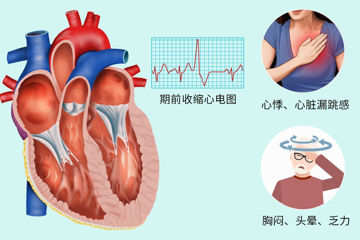 期前收缩图片