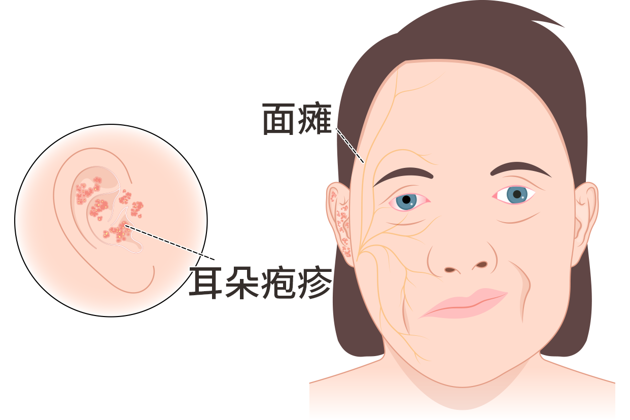 面瘫、耳朵疱疹图