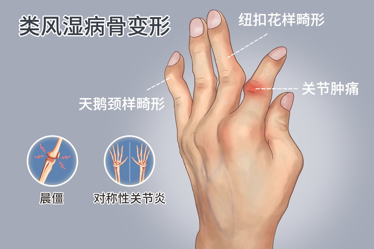 风湿热的症状与治疗图片