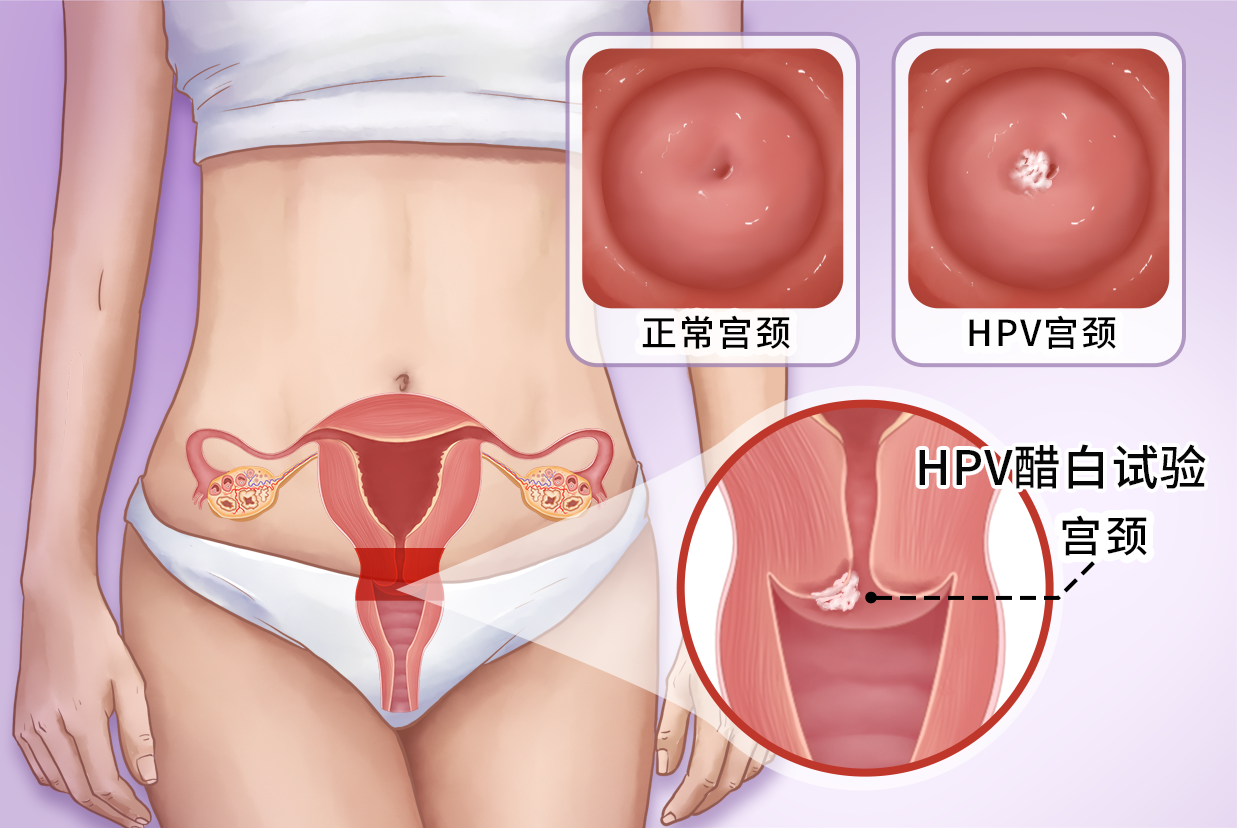 HPV醋白试验图片