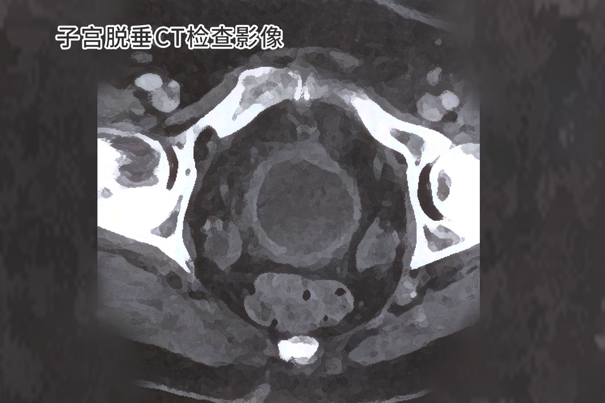 子宫脱垂CT检查影像图片
