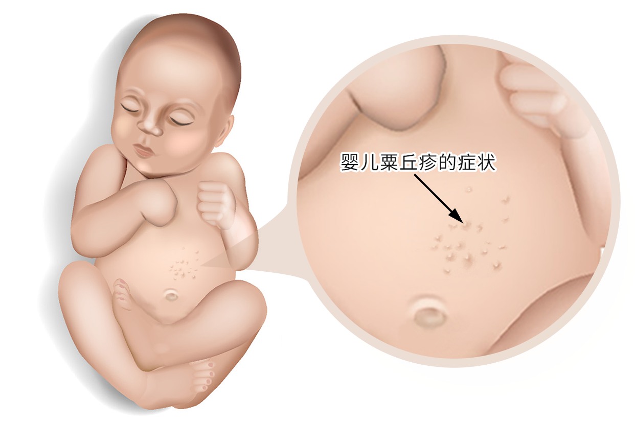 婴儿粟丘疹的症状图片