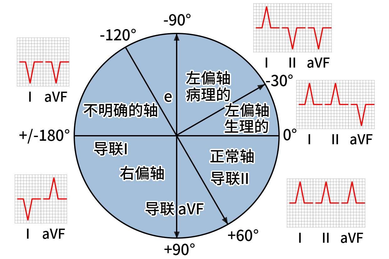 心电图电轴左偏右偏怎么看图片