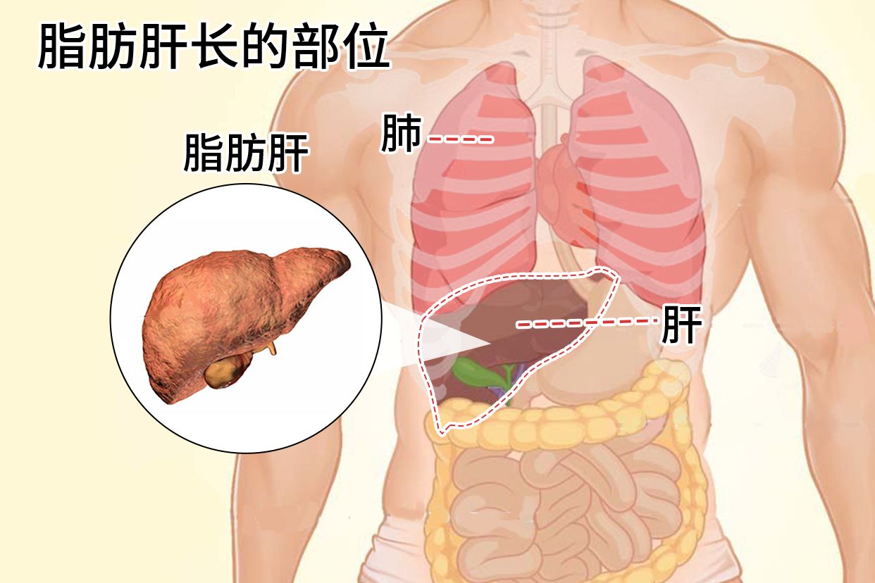 长脂肪肝的部位图