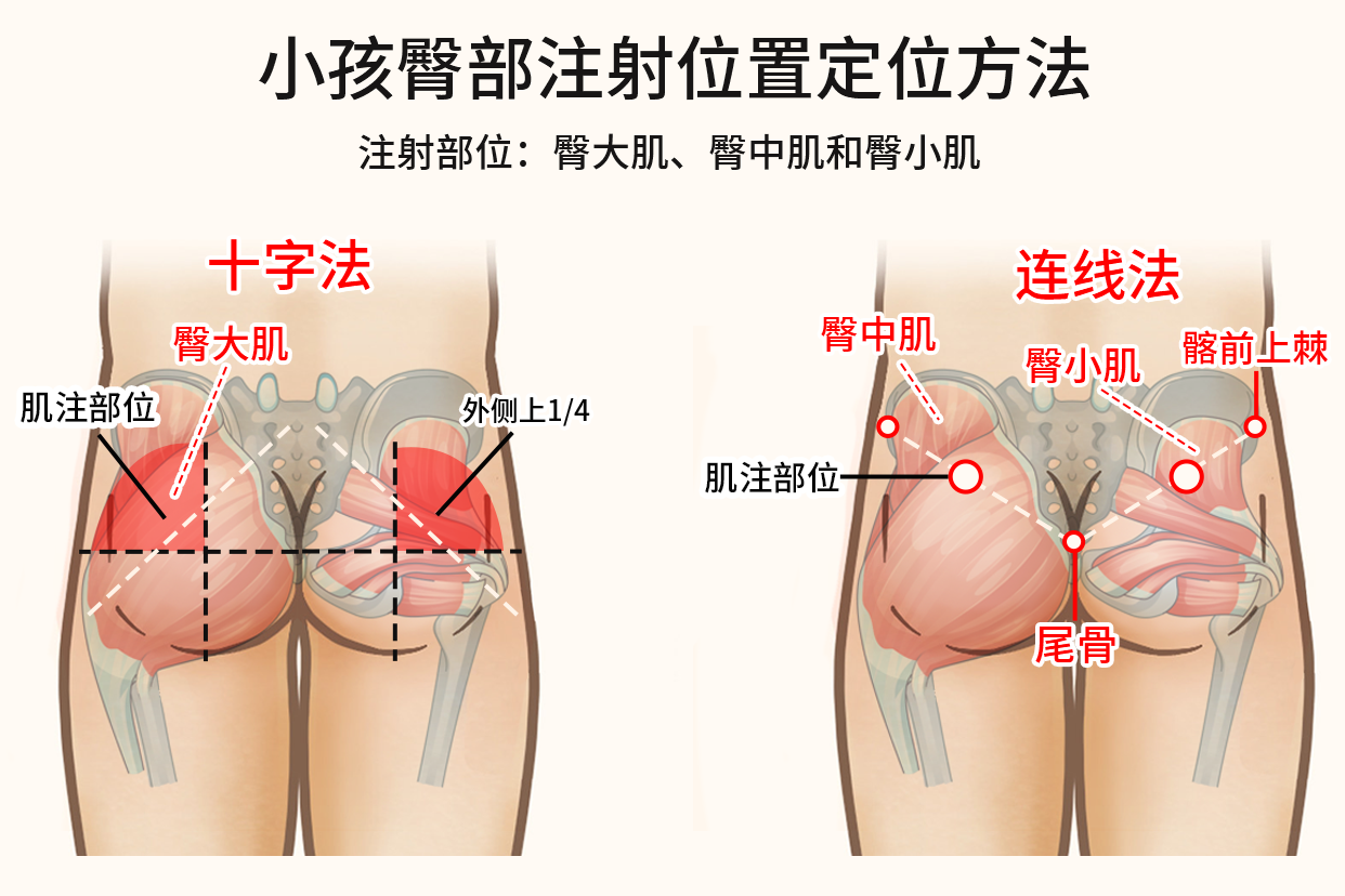 臀中肌十字定位法图图片