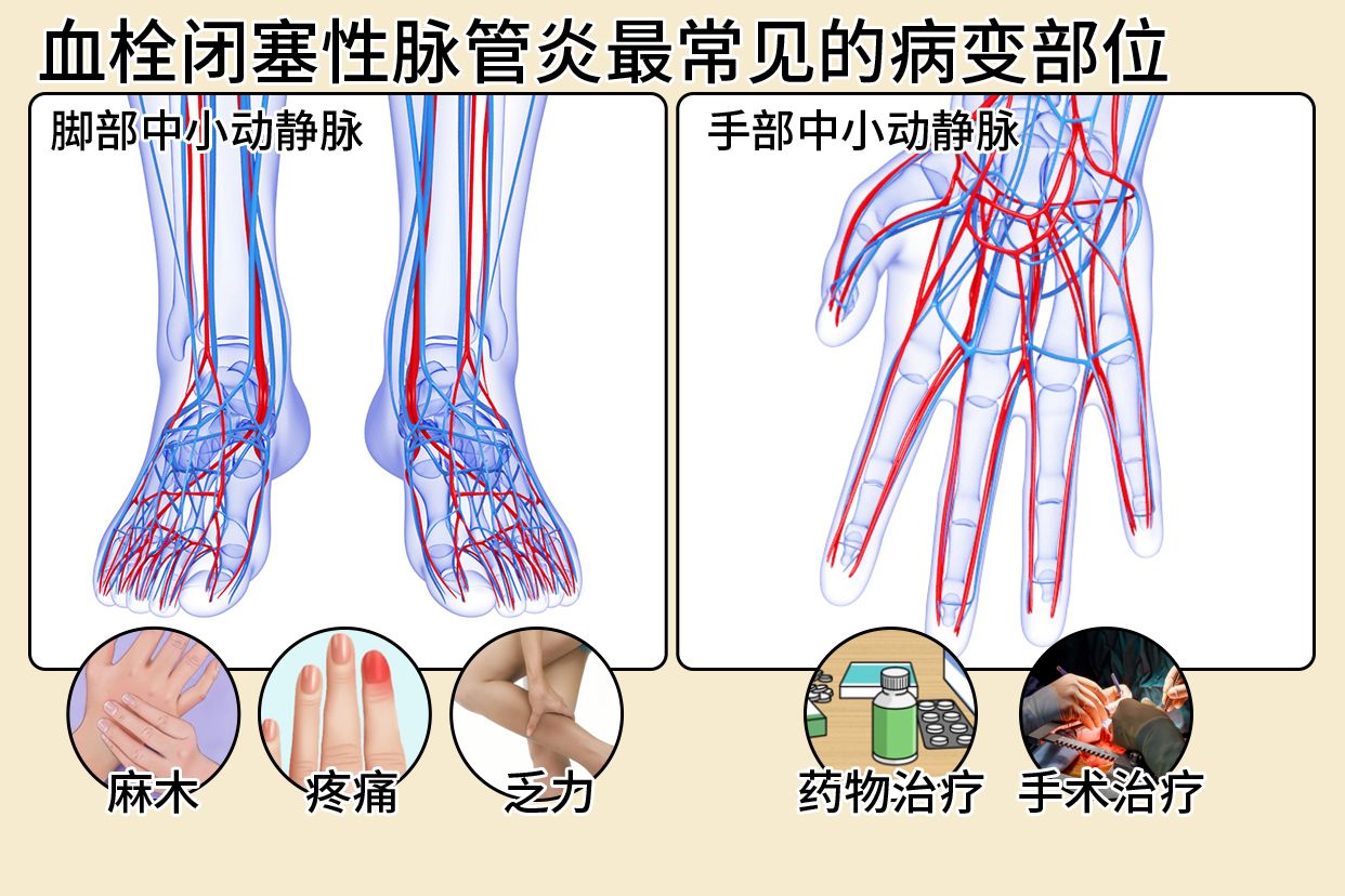 血栓闭塞性脉管炎最常见的病变部位图片